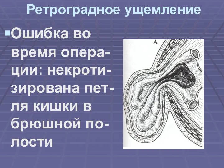 Ретроградное ущемление Ошибка во время опера-ции: некроти-зирована пет-ля кишки в брюшной по-лости