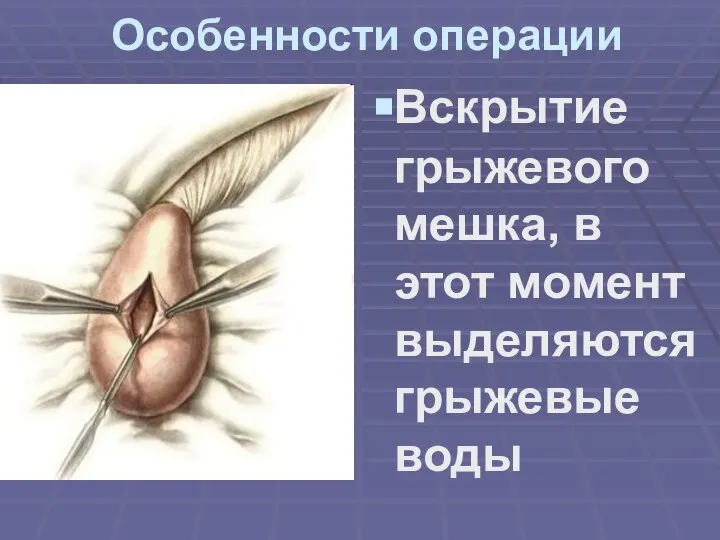 Особенности операции Вскрытие грыжевого мешка, в этот момент выделяются грыжевые воды