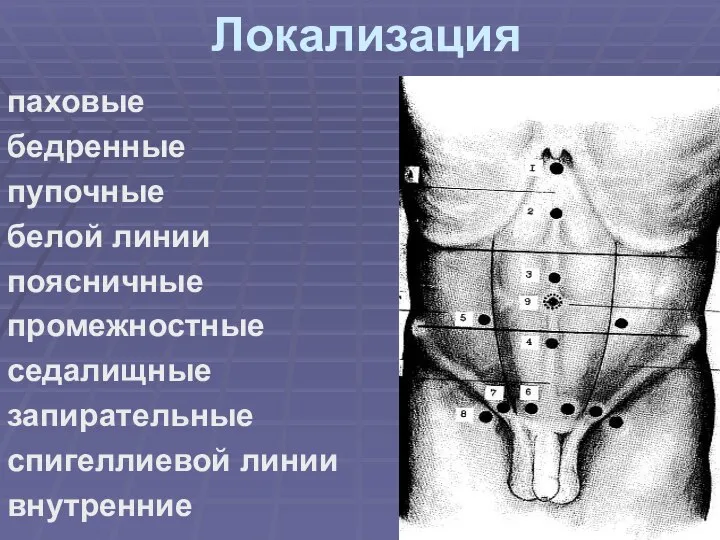 Локализация паховые бедренные пупочные белой линии поясничные промежностные седалищные запирательные спигеллиевой линии внутренние