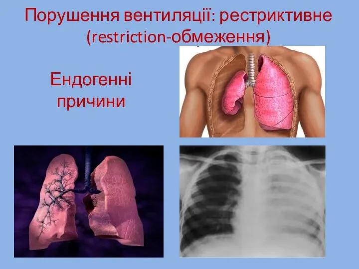 Порушення вентиляції: рестриктивне (restriction-обмеження) Ендогенні причини