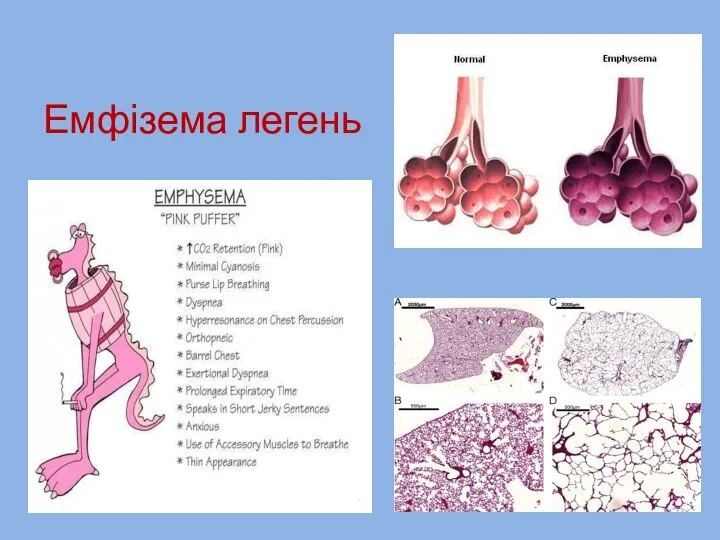 Емфізема легень