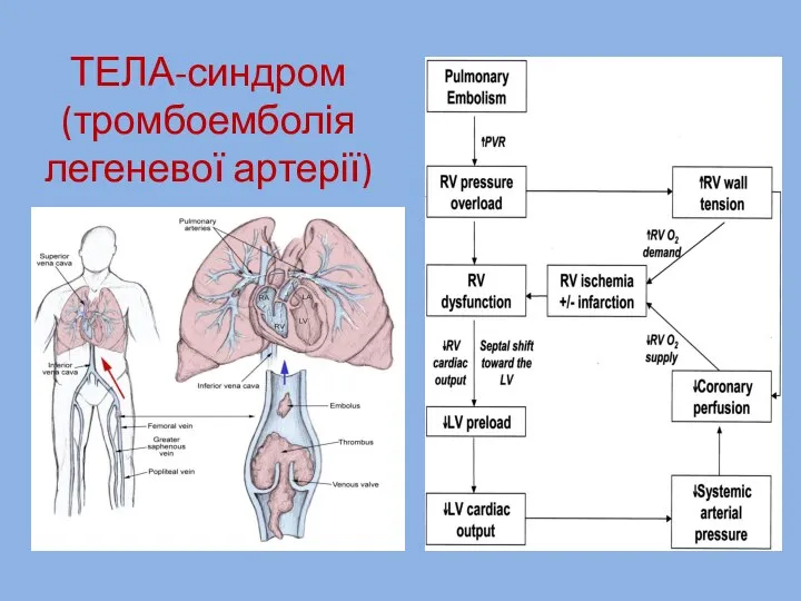 ТЕЛА-синдром (тромбоемболія легеневої артерії)