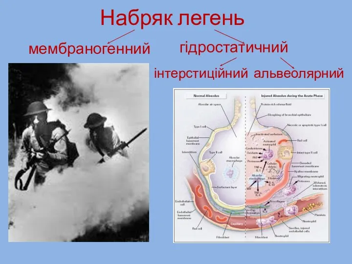 Набряк легень мембраногенний гідростатичний альвеолярний інтерстиційний