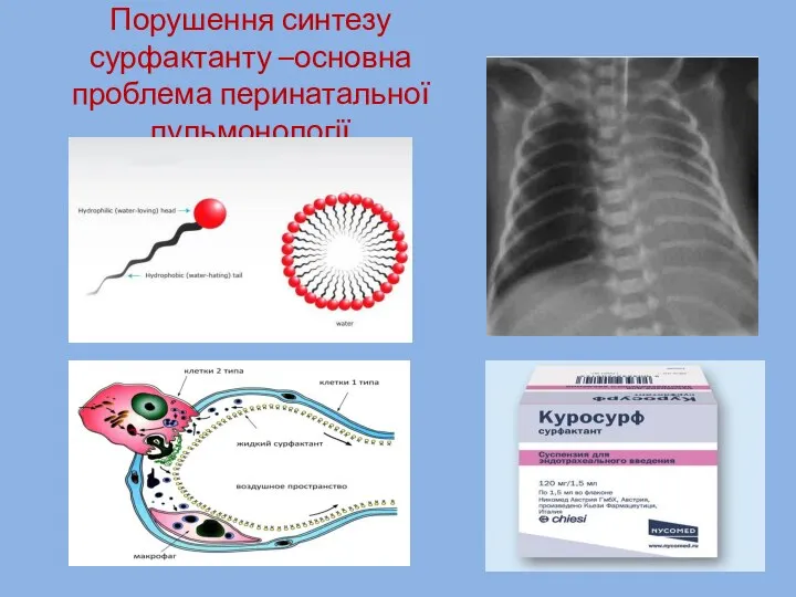 Порушення синтезу сурфактанту –основна проблема перинатальної пульмонології