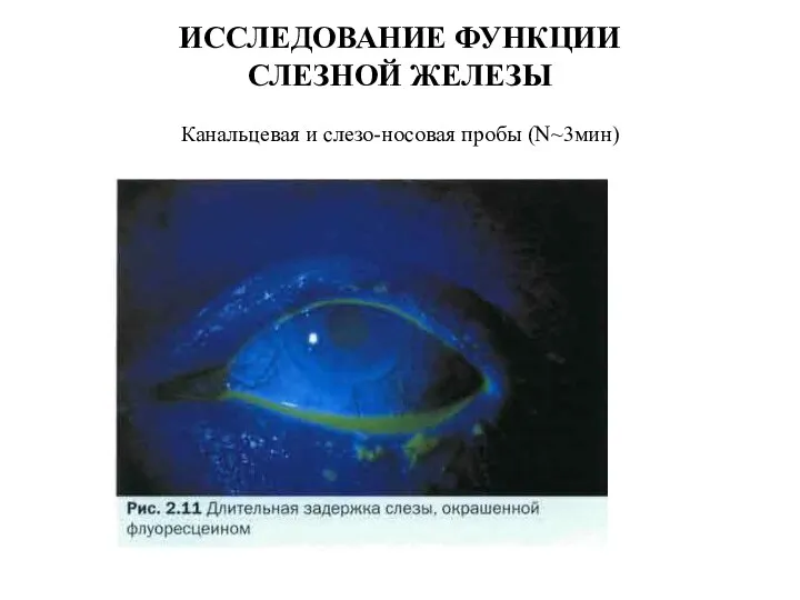 ИССЛЕДОВАНИЕ ФУНКЦИИ СЛЕЗНОЙ ЖЕЛЕЗЫ Канальцевая и слезо-носовая пробы (N~3мин)