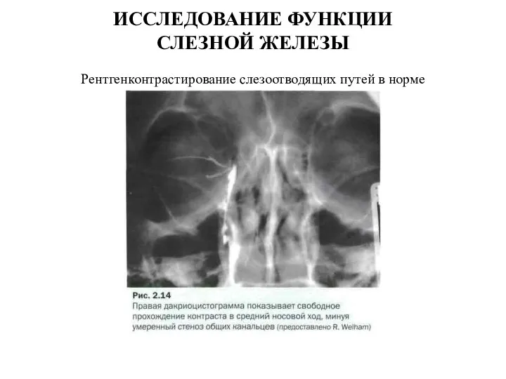 ИССЛЕДОВАНИЕ ФУНКЦИИ СЛЕЗНОЙ ЖЕЛЕЗЫ Рентгенконтрастирование слезоотводящих путей в норме