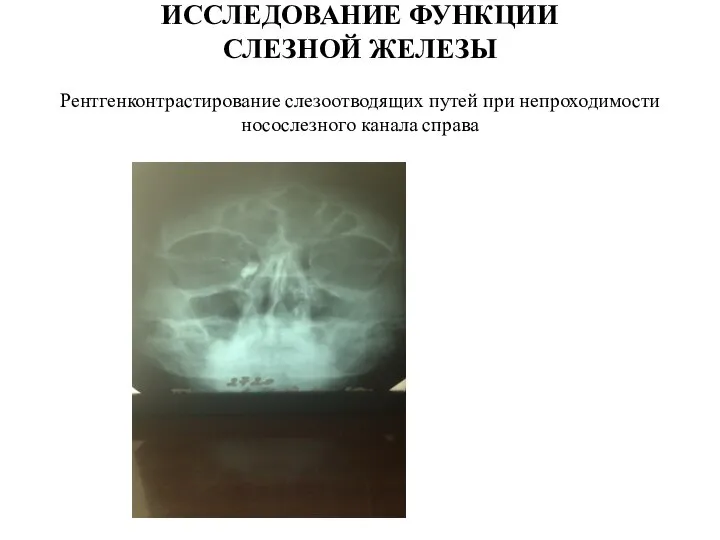 ИССЛЕДОВАНИЕ ФУНКЦИИ СЛЕЗНОЙ ЖЕЛЕЗЫ Рентгенконтрастирование слезоотводящих путей при непроходимости носослезного канала справа