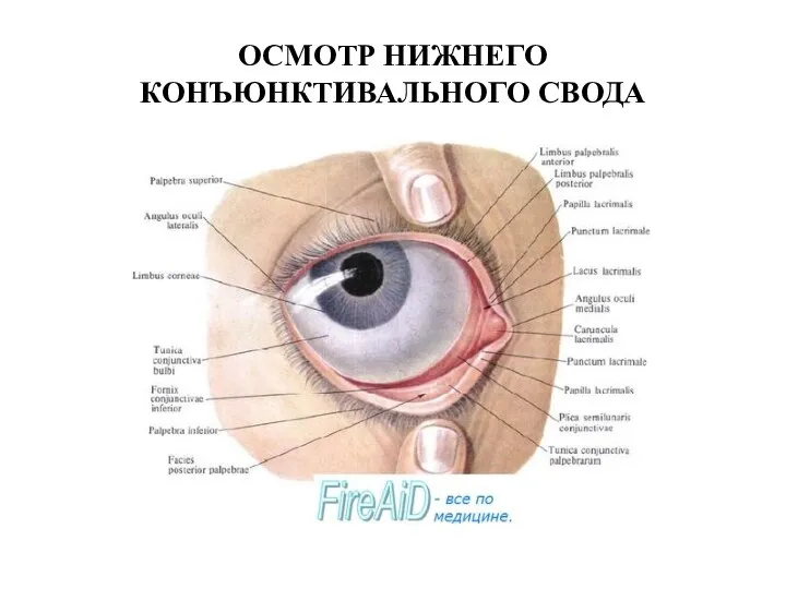 ОСМОТР НИЖНЕГО КОНЪЮНКТИВАЛЬНОГО СВОДА