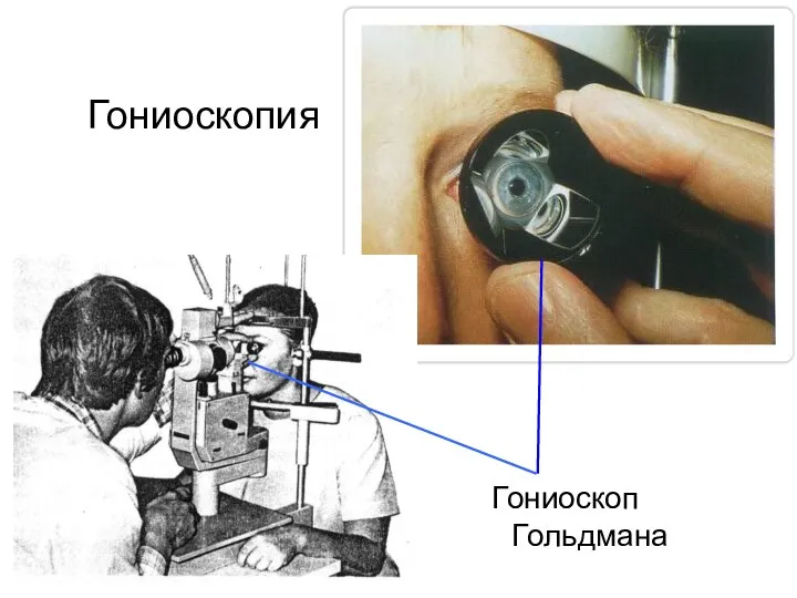 Гониоскоп Гольдмана Гониоскопия