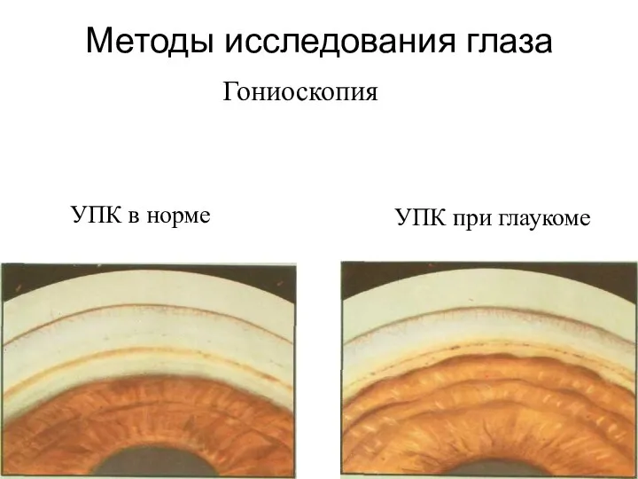 Методы исследования глаза Гониоскопия УПК в норме УПК при глаукоме