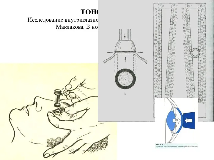 ТОНОМЕТРИЯ Исследование внутриглазного давления с помощью тонометра Маклакова. В норме ВГД 18-25 мм.рт.ст.