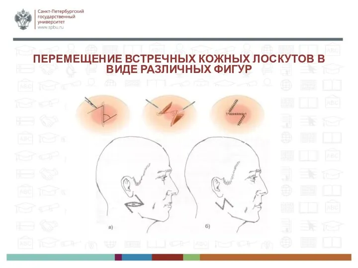 ПЕРЕМЕЩЕНИЕ ВСТРЕЧНЫХ КОЖНЫХ ЛОСКУТОВ В ВИДЕ РАЗЛИЧНЫХ ФИГУР