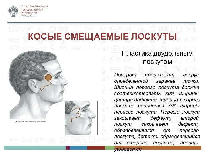 КОСЫЕ СМЕЩАЕМЫЕ ЛОСКУТЫ Пластика двудольным лоскутом Поворот происходит вокруг определенной заранее точки.