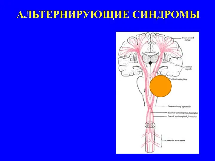 АЛЬТЕРНИРУЮЩИЕ СИНДРОМЫ