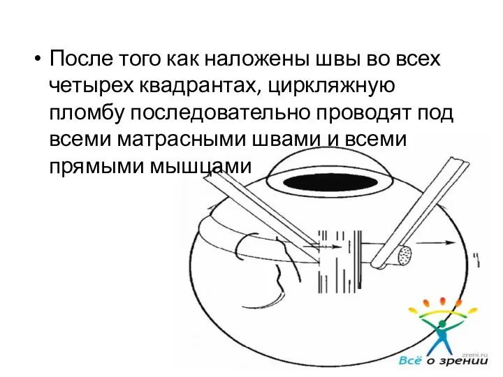 После того как наложены швы во всех четырех квадрантах, циркляжную пломбу последовательно