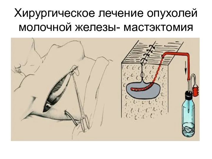 Хирургическое лечение опухолей молочной железы- мастэктомия