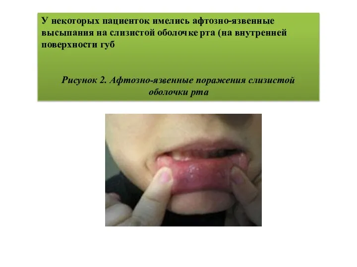 У некоторых пациенток имелись афтозно-язвенные высыпания на слизистой оболочке рта (на внутренней