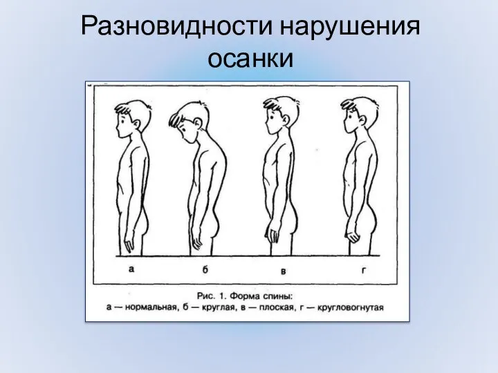 Разновидности нарушения осанки