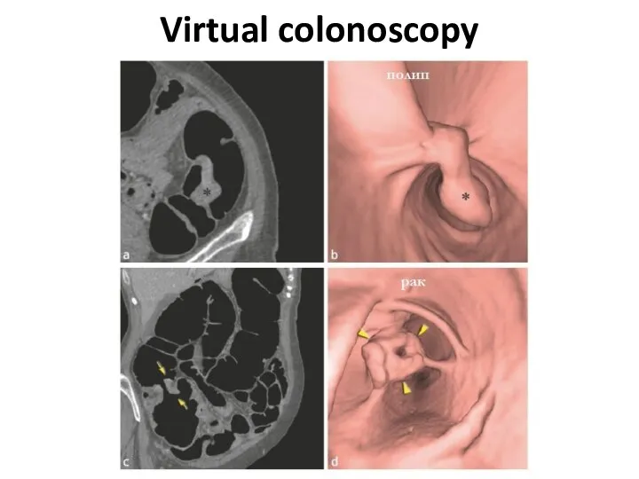 Virtual colonoscopy