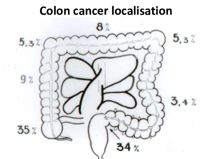 Colon cancer localisation