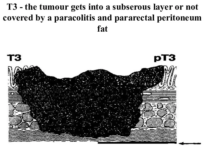 Т3 - the tumour gets into a subserous layer or not covered