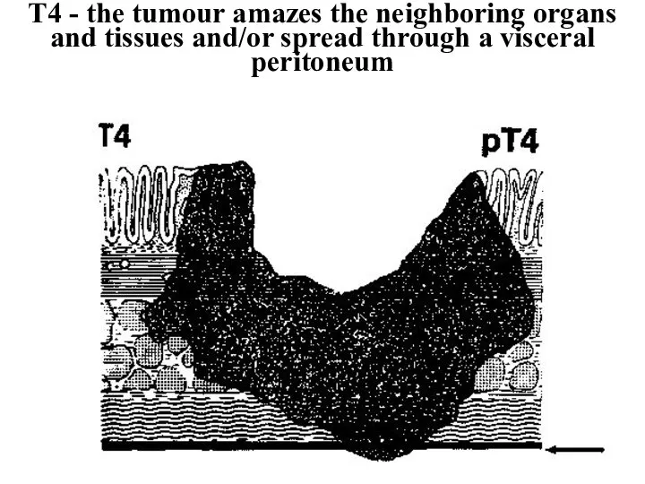 Т4 - the tumour amazes the neighboring organs and tissues and/or spread through a visceral peritoneum