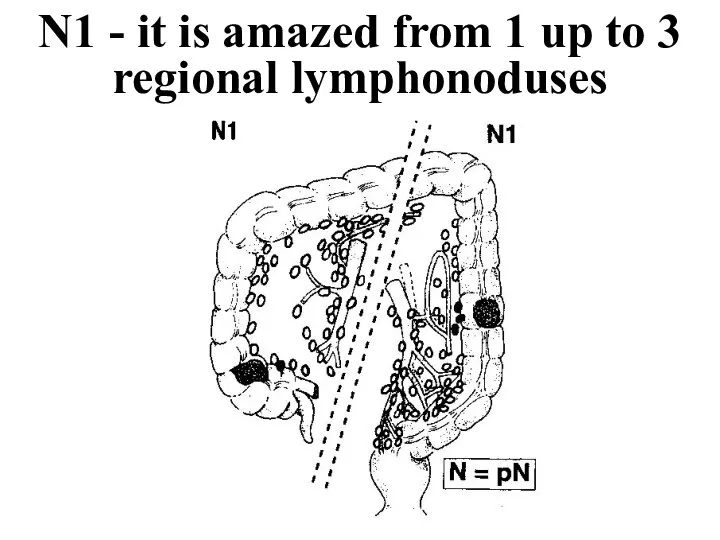 N1 - it is amazed from 1 up to 3 regional lymphonoduses