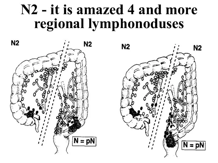 N2 - it is amazed 4 and more regional lymphonoduses