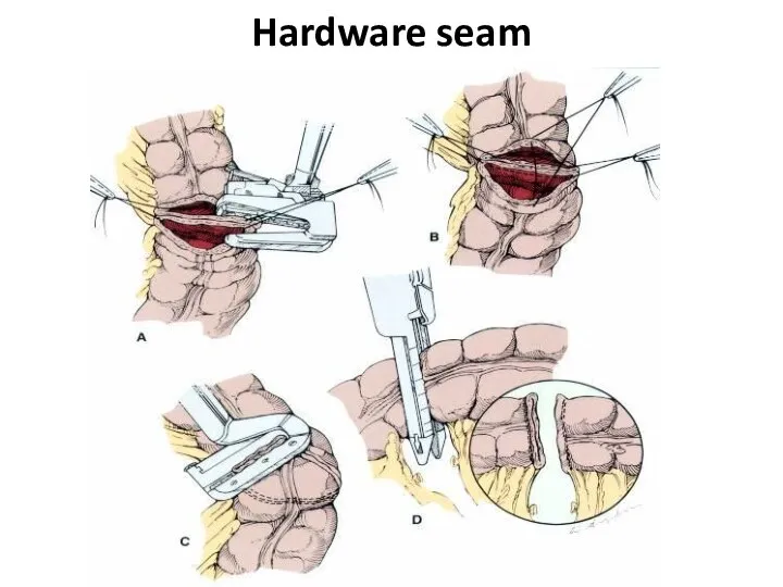 Hardware seam