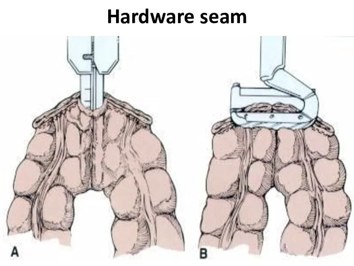 Hardware seam