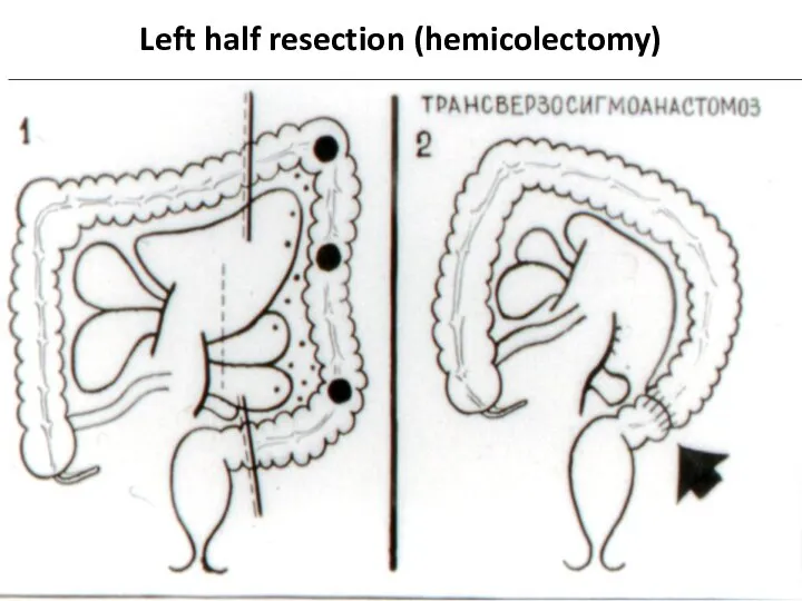 Left half resection (hemicolectomy)