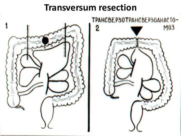 Transversum resection