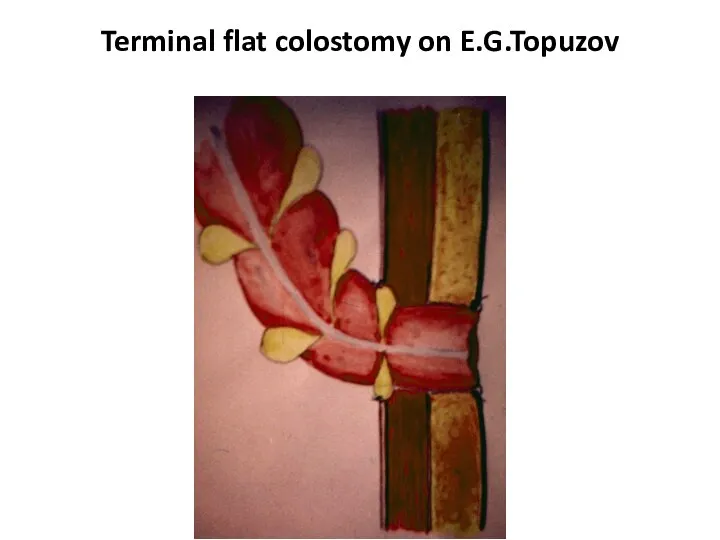 Terminal flat colostomy on E.G.Topuzov