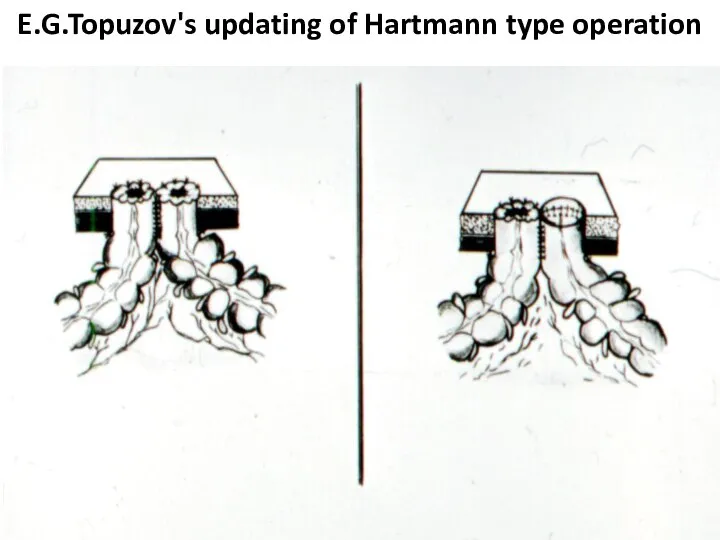 E.G.Topuzov's updating of Hartmann type operation