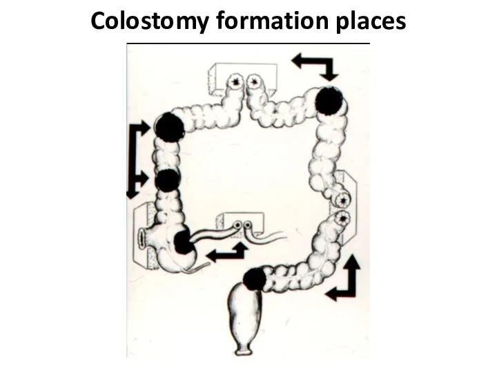 Colostomy formation places