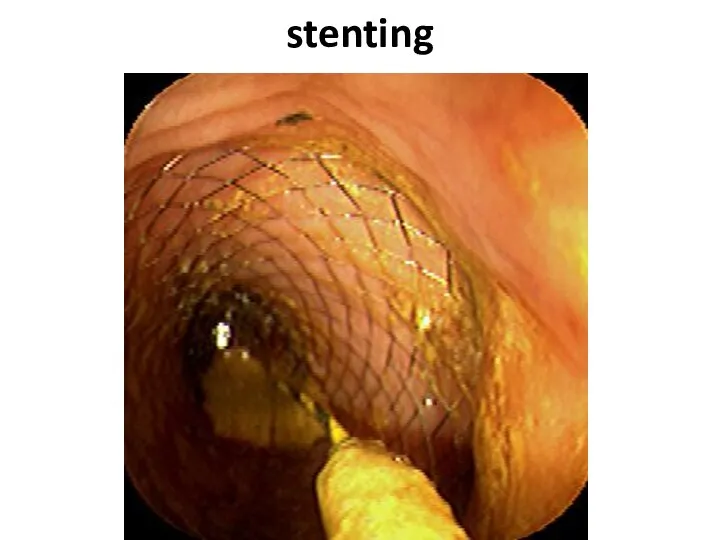 stenting