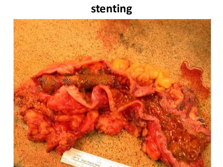 stenting