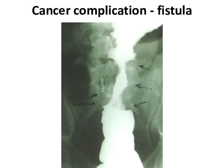 Cancer complication - fistula