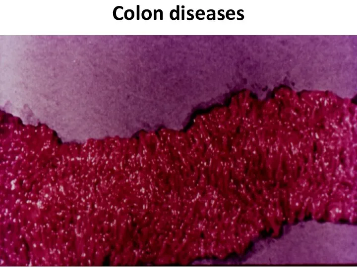 Colon diseases