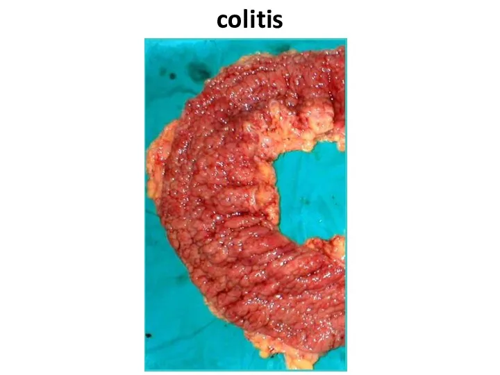 colitis