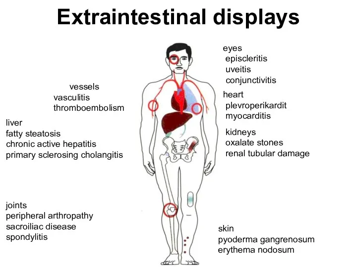 Extraintestinal displays vessels vasculitis thromboembolism liver fatty steatosis chronic active hepatitis primary