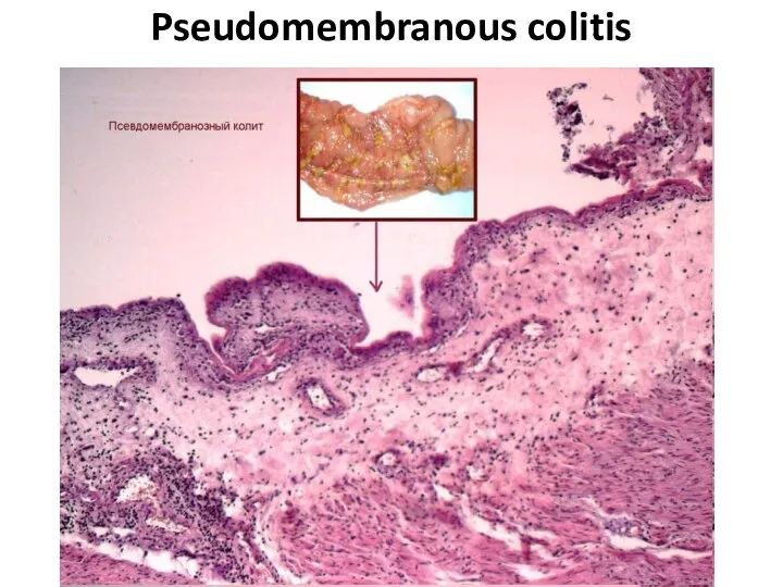 Pseudomembranous colitis