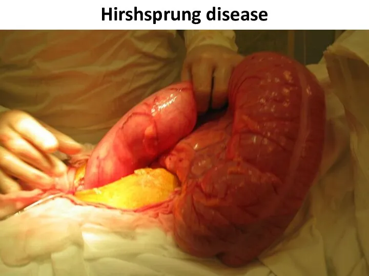 Hirshsprung disease