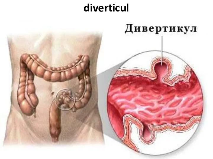 diverticul