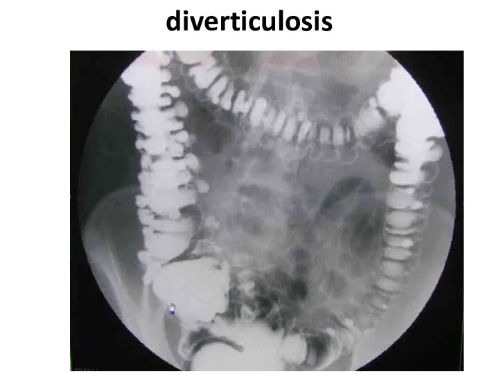 diverticulosis