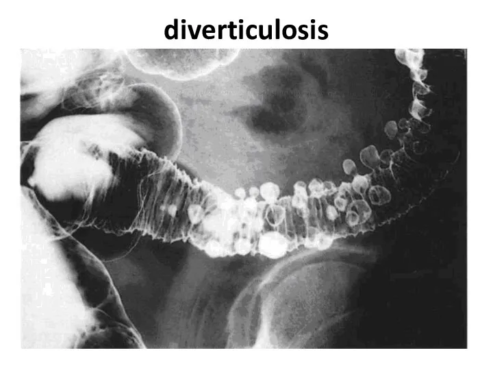 diverticulosis