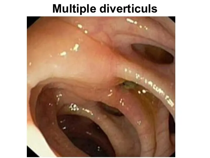 Multiple diverticuls