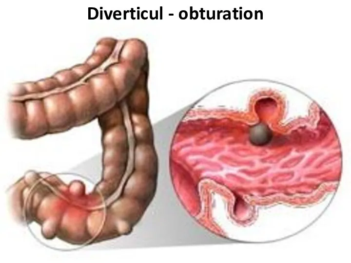 Diverticul - obturation