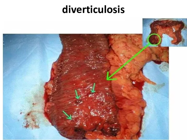 diverticulosis