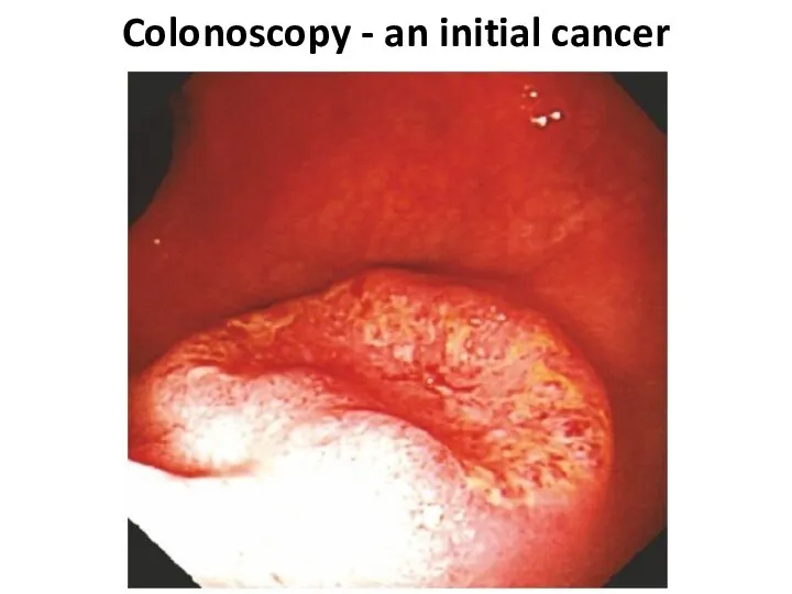 Colonoscopy - an initial cancer